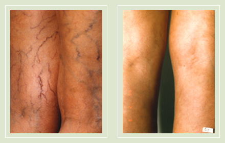 before after pictures dark veins treatment legs-18