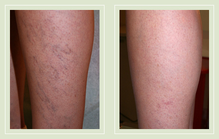 before after pictures spider vein treatment legs-17
