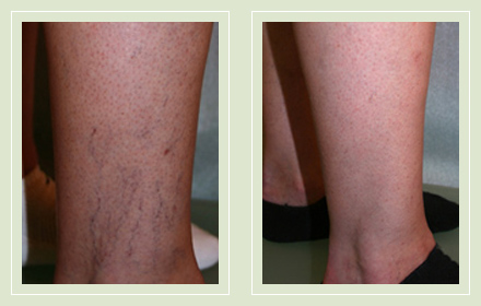 before after pictures spider vein treatment legs-16