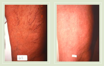before after pictures spider vein treatment legs-17