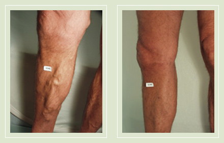 before after pictures varicose vein treatment legs male-16
