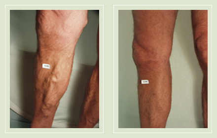 Phlebectomy, venectomy  How to remove varicose veins before