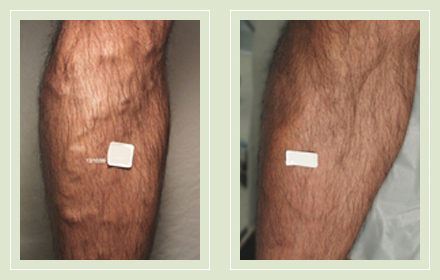 before after pictures varicose vein treatment legs male-15
