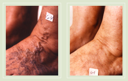 before after pictures varicose veins treatment legs 14
