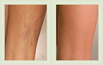 before after pictures spider vein treatment legs-33