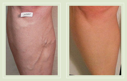 varicose-vein-before-after-pics-female-legs