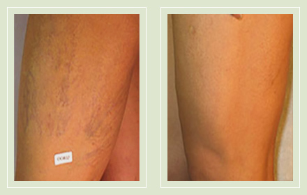 before after pictures spider vein treatment legs-30