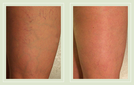 before after pictures varicose spider vein treatment legs-29