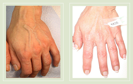 varicose-hand-vein-treatment-before-after-pics-1