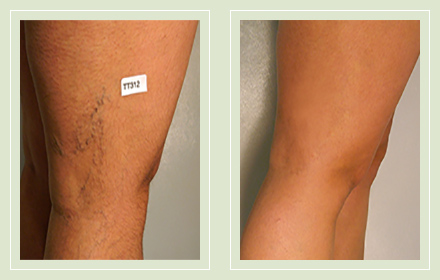 before after pictures spider vein treatment legs-34