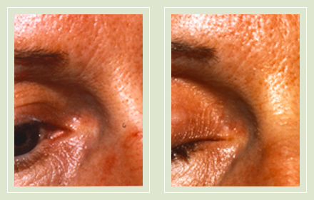 spider-facial-veins-treatment-nose-before-after-pics-01