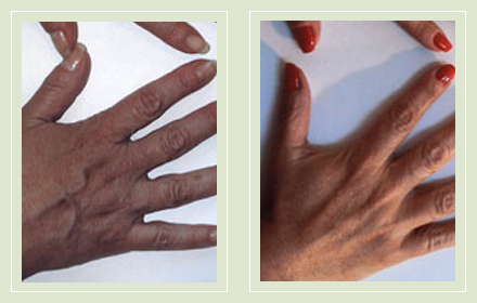 hand-vein-removal-before-after-pics-9