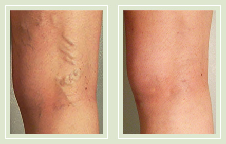 before after pictures varicose veins treatment legs-27