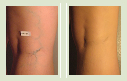 before after pictures varicose veins treatment legs-28