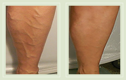 before after pictures varicose vein treatment legs-31