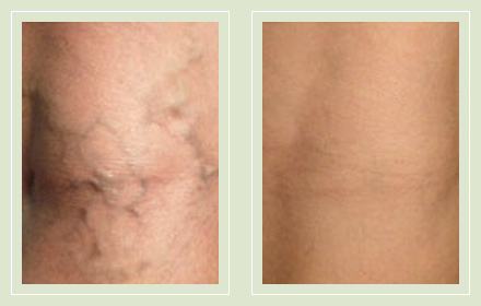 before after pictures small varicose veins treatment legs-20