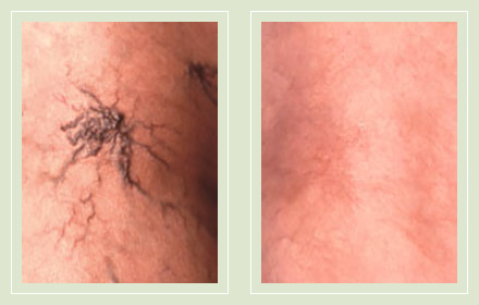 before after pictures varicose veins treatment legs-22