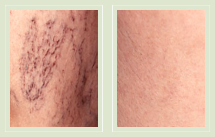 before after pictures spider vein treatment legs-21