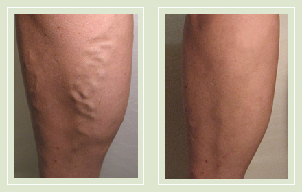 before after pictures varicose vein treatment legs-19