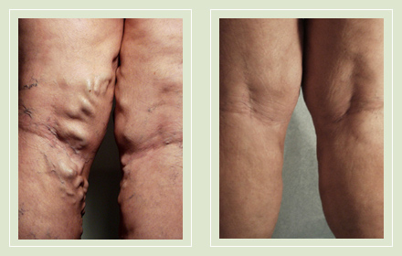 before after pictures extreme varicose vein treatment legs-18