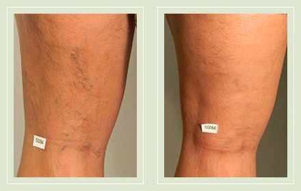 before after pictures varicose veins treatment legs-23