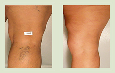 before after pictures spider veins treatment legs-26