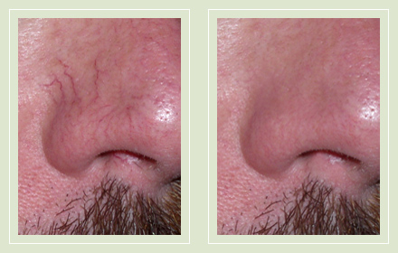 Before and After Pic-Nose Sclerotherapy