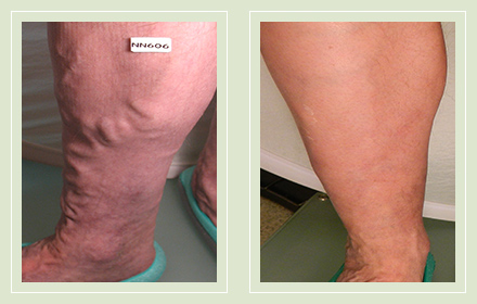 before after pictures large varicose veins treatment legs-24