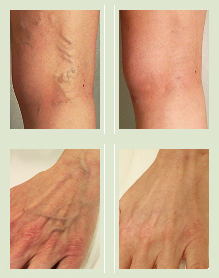 Spider & Varicose Vein Treatments & Removal - Westlake Dermatology