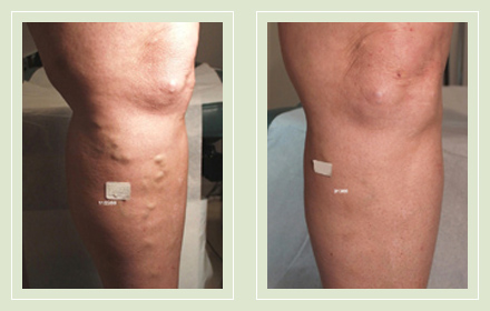 before after pictures varicose vein treatment legs-18