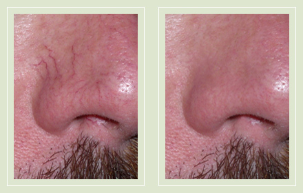 Before and after nose face vein laser therapy 42yo